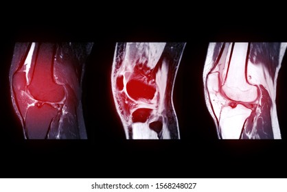 Compare of MRI Knee joint or Magnetic resonance imaging  sagital view for detect tear or sprain of the anterior cruciate  ligament (ACL).