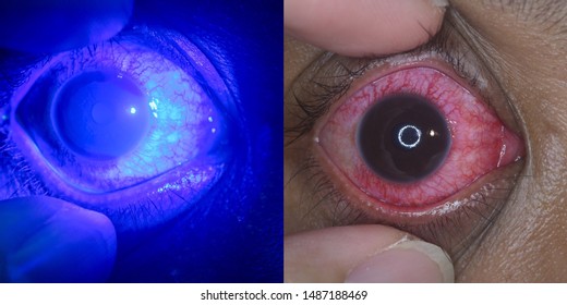 Compare normal with fluoresciene stain, close up of the chemical injury during eye examination.
