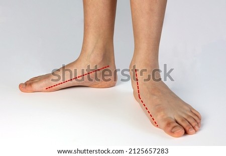 Compare normal healthy foot shape with flat foot fallen arch problem. The red line showing normal shape foot with abnormal shapes foot unstable medial column.