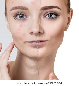 Compare Of Old Photo With Acne And Healthy Skin.