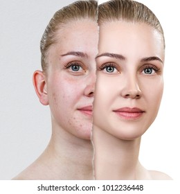 Compare Of Old Photo With Acne And New Healthy Skin.