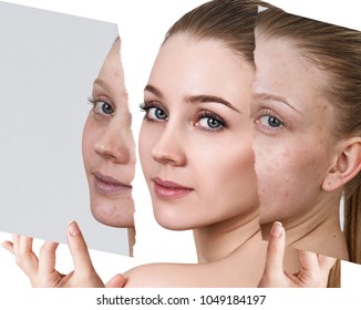 Compare Of Old Photo With Acne And New Healthy Skin.