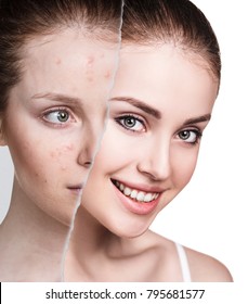 Compare Of Old Photo With Acne And New Healthy Skin.