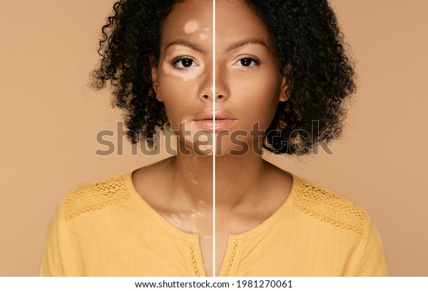 Compare woman face with and without vitiligo.\
Vitiligo skin pigmentation\
treatment