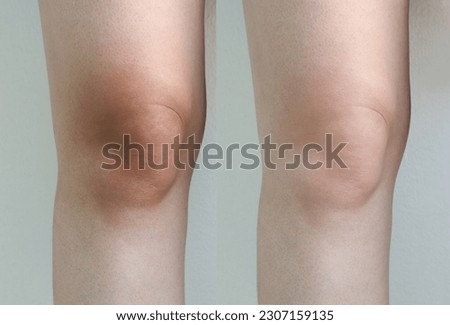 Compare woman knee before and after use skin care whitening cream treatment with dark, wrinkle skin rough and dry,Lack elasticity, Aging skin problem, Dermatology body skincare concept.