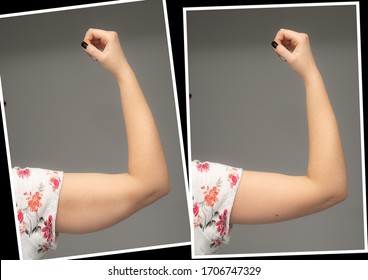 Comparison before and after excess skin removal under arm, results of brachioplasty surgery. Young caucasian female hand against grey background. Health care concept.
