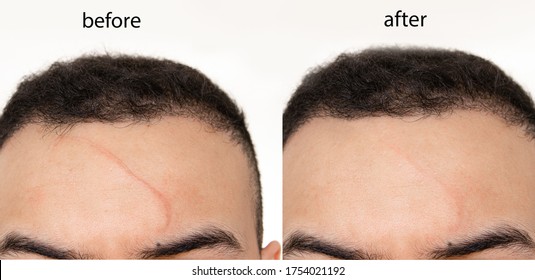  Comparison Of  Before And After Scar Revision (treatment ) Using Laser , Led  And Creams On A Man's Forehead (face)