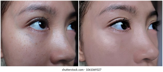 Comparison Of Before And After Undergone Skin Treatment And Makeup.