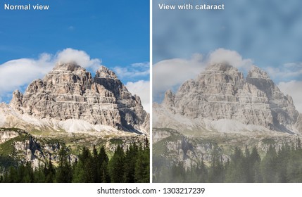 Comparison Between A Normal View And View Of Patient Suffering From Cataract