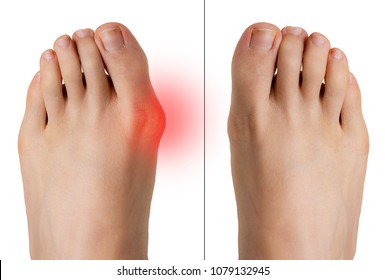 Comparison Of Bunion Before And After Correction Surgery