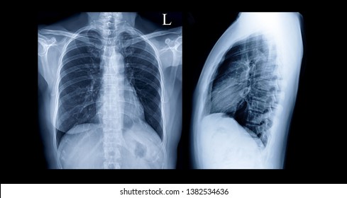 Comparison Chest Xray Pa Lateral View Stock Photo 1382534636 | Shutterstock