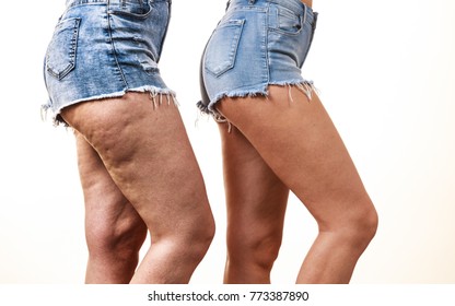 Comparison of female legs thighs with and without cellulite. Skin problem, body care, overweight and dieting concept. - Shutterstock ID 773387890