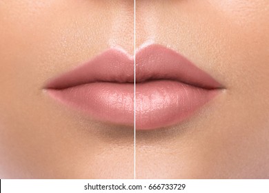 Comparison of female lips before and after augmentation 