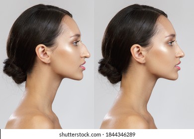 Comparison of the female nose after plastic surgery. Before after. Rhinoplasty