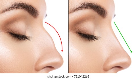 Comparison Of Female Nose After Plastic Surgery