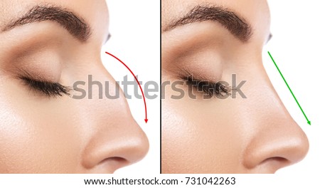 Comparison of Female nose after plastic surgery