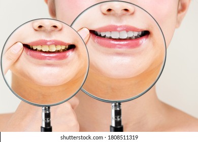 Comparison of female white and yellowed teeth.
