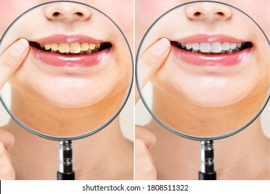 Comparison of female white and yellowed teeth.