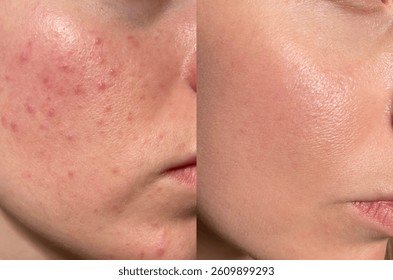 Comparación de la Imagen de la cara propensa al acné antes y después del tratamiento del cuidado de la piel. Muestra reducción de manchas, enrojecimiento y mejora la claridad y el brillo de la piel.