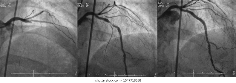 Comparison Of Left Anterior Descending Artery (LAD) Between Before And After Percutaneous Coronary Intervention (PCI)