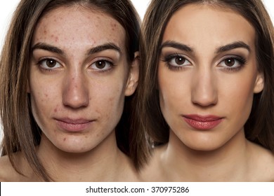 Comparison portrait of a woman with problematic skin without and with makeup