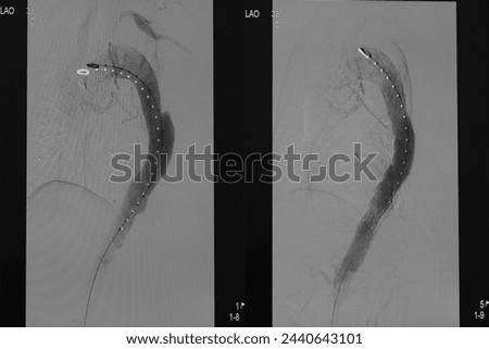 Comparison of pre-post thoracic endovascular aneurysm repair (TEVAR) at descending aorta with aortic stent graft.