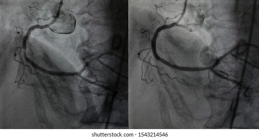 Comparison Of Right Coronary Artery Angiogram Between Before And After Percutaneous Coronary Intervention