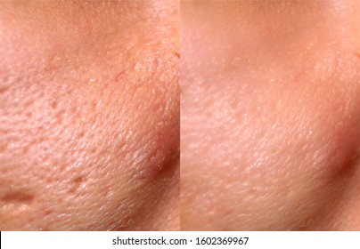 Comparison Of Skin Before And After Laser Resurfacing. Skin With Acne, Acne Scars, Enlarged Pores.