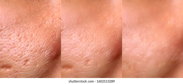 Comparison of skin before and after laser resurfacing. Skin with acne, acne scars, enlarged pores. - Shutterstock ID 1602513289