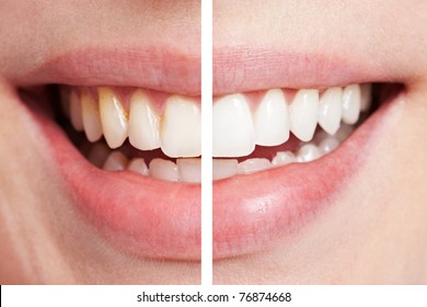 Comparison Of Teeth Before And After Bleaching Session