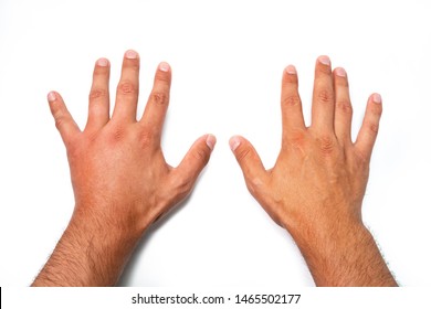 Comparison Of Two Male Hands Stung By Bee Or Wasp. Hand Swelling, Inflammation, Redness Are Signs Of Infection. Insect Bite On Left Hand On White Background