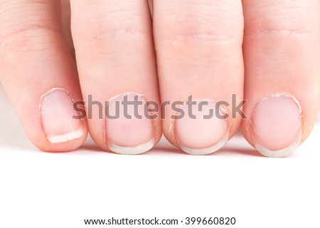 Comparison of the ugly manicure