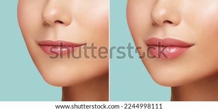 Comparison of Women lips correction before and after Hyaluronic acid injection. Injected and non-injected lips. Beauty lip treatment procedure. Natural lips shape. Lips Augmentation