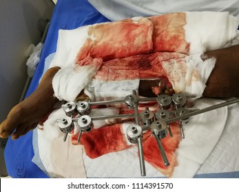 Compartment Syndrome,external Fixation, Motorcycle Accident 