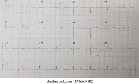 Complete Heart Block. 3rd Degree AV Block (nodal Block).