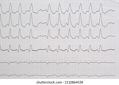 Complete Right Bundle Branch Block On An Electrocardiogram 