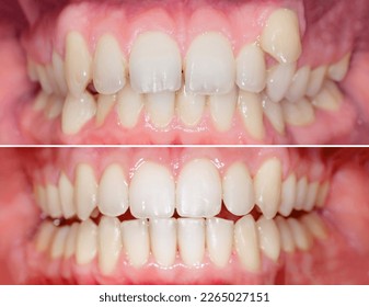 Complete smile makeover from crooked teeth to well aligned smile. Before after after using aligners invisalign or brackets
