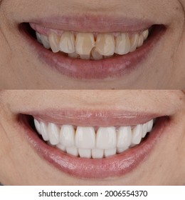 Complete Smile Makeover From Darken Teeth And Crooked Teeth To White And Well Aligned Smile.