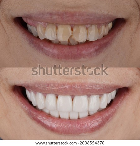 Complete smile makeover from darken teeth and crooked teeth to white and well aligned smile.
