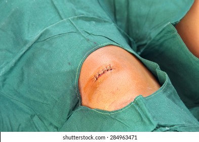 complete stitches of incised wound.