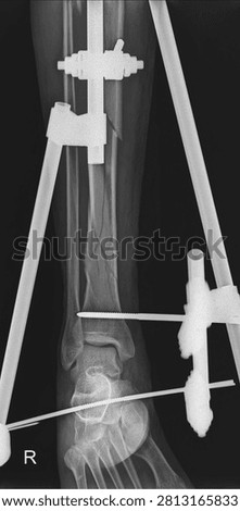 Complex Tibia-Fibula Fracture with External Fixation