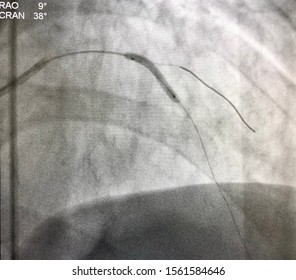 A Compliant Balloon Catheter Was Inflated At Left Coronary Artery During Percutaneous Coronary Intervention (PCI).