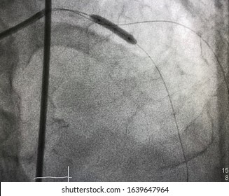 Compliant Balloton Cathheter Was Inflated At Left Anterior Descending Artery (LAD) During Percutaneous Coronary Intervention (PCI).