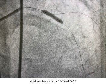 Compliant Balloton Cathheter Was Inflated At Left Anterior Descending Artery (LAD) During Percutaneous Coronary Intervention (PCI).