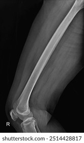 Comprehensive Bone Structure Analysis: A Guide to Femur  X-Ray Diagnosis