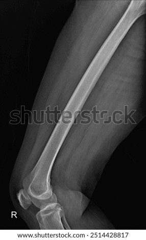Comprehensive Bone Structure Analysis: A Guide to Femur  X-Ray Diagnosis