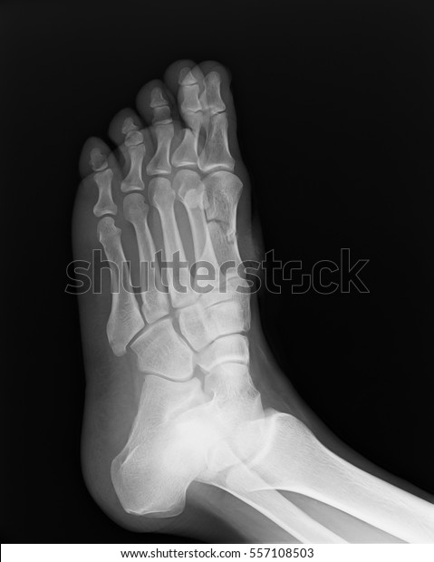 Computed Radiography Cr Foot Oblique View Stock Photo (Edit Now) 557108503