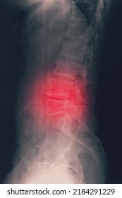 Computed Radiography (CR) Of Lumbosarcal Spine  Lateral Showing Spondylosis And Scoliosis Spine.