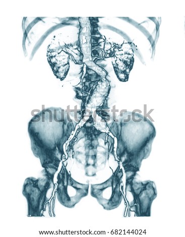 Computed tomography angiography (also called CT angiography or CTA), Abdominal aneurysm