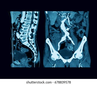 Computed Tomography Angiography (CT Angiography Or CTA)